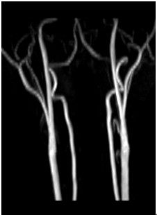 非增強(qiáng)磁共振頸部動脈血管成像.jpg